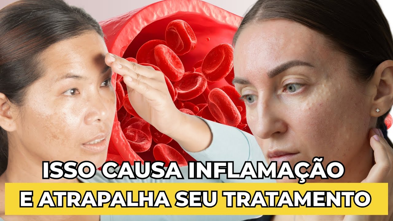 Isso piora o seu melasma ! 