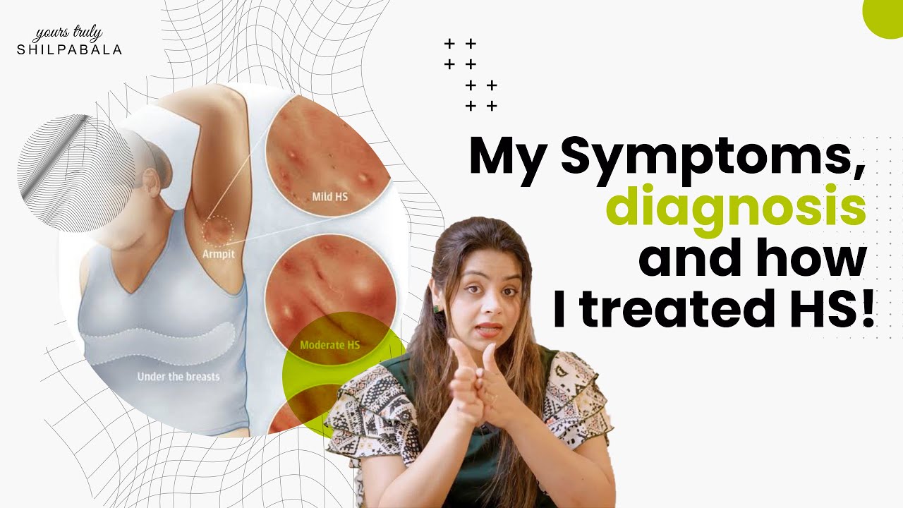 All you want to know about my skin condition| HS | Symptoms and treatment&nbsp;|&nbsp;Shilpa&nbsp;Bala |