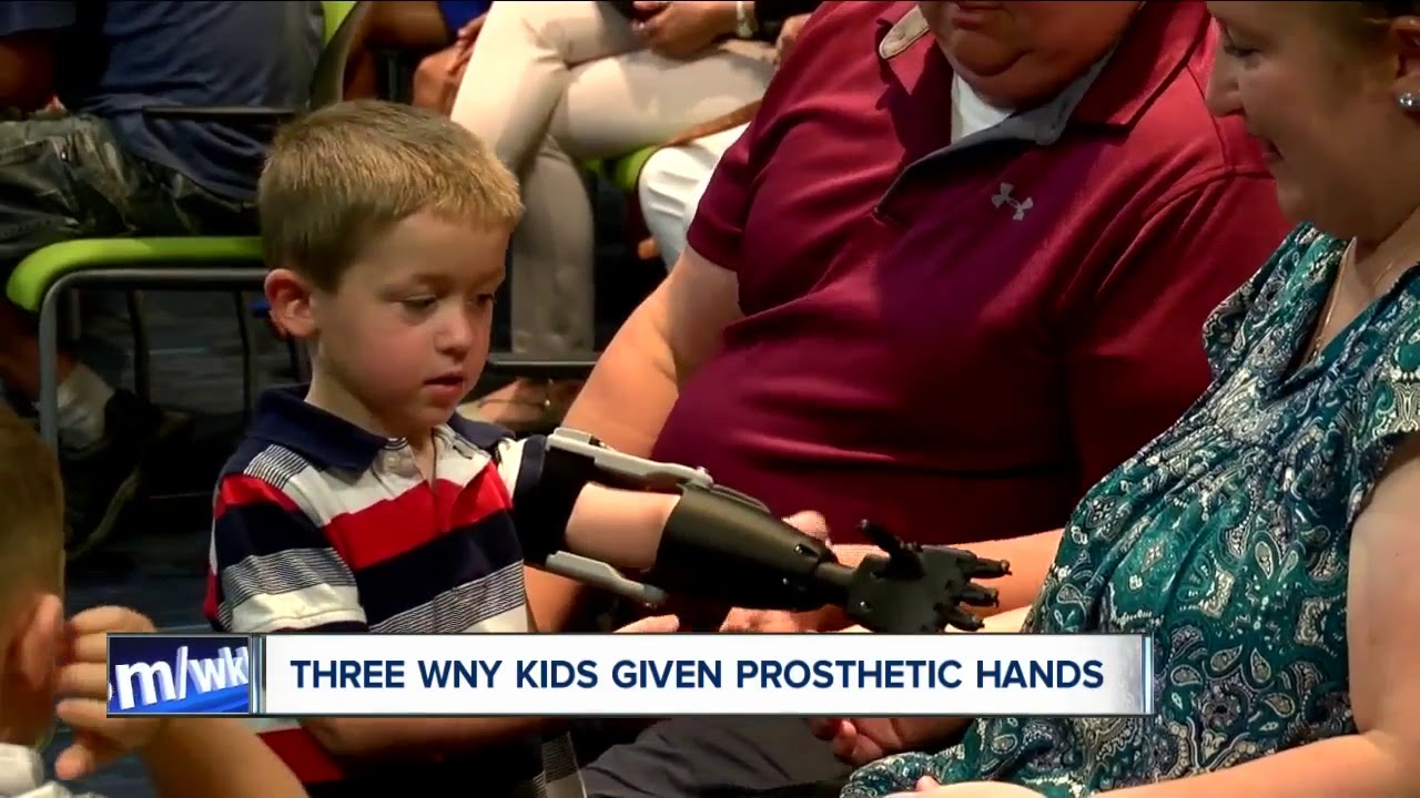Three kids given new prosthetic hands