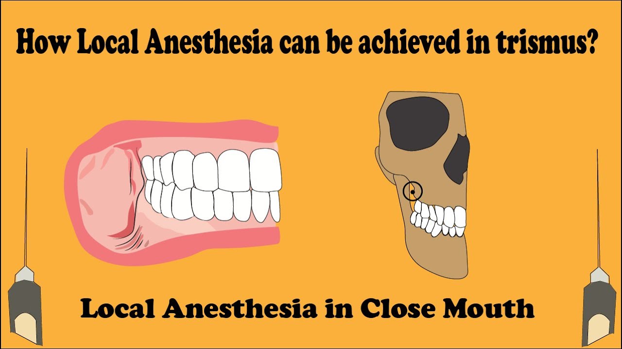 Close Mouth Mandibular block | Vazirani Akinosi technique