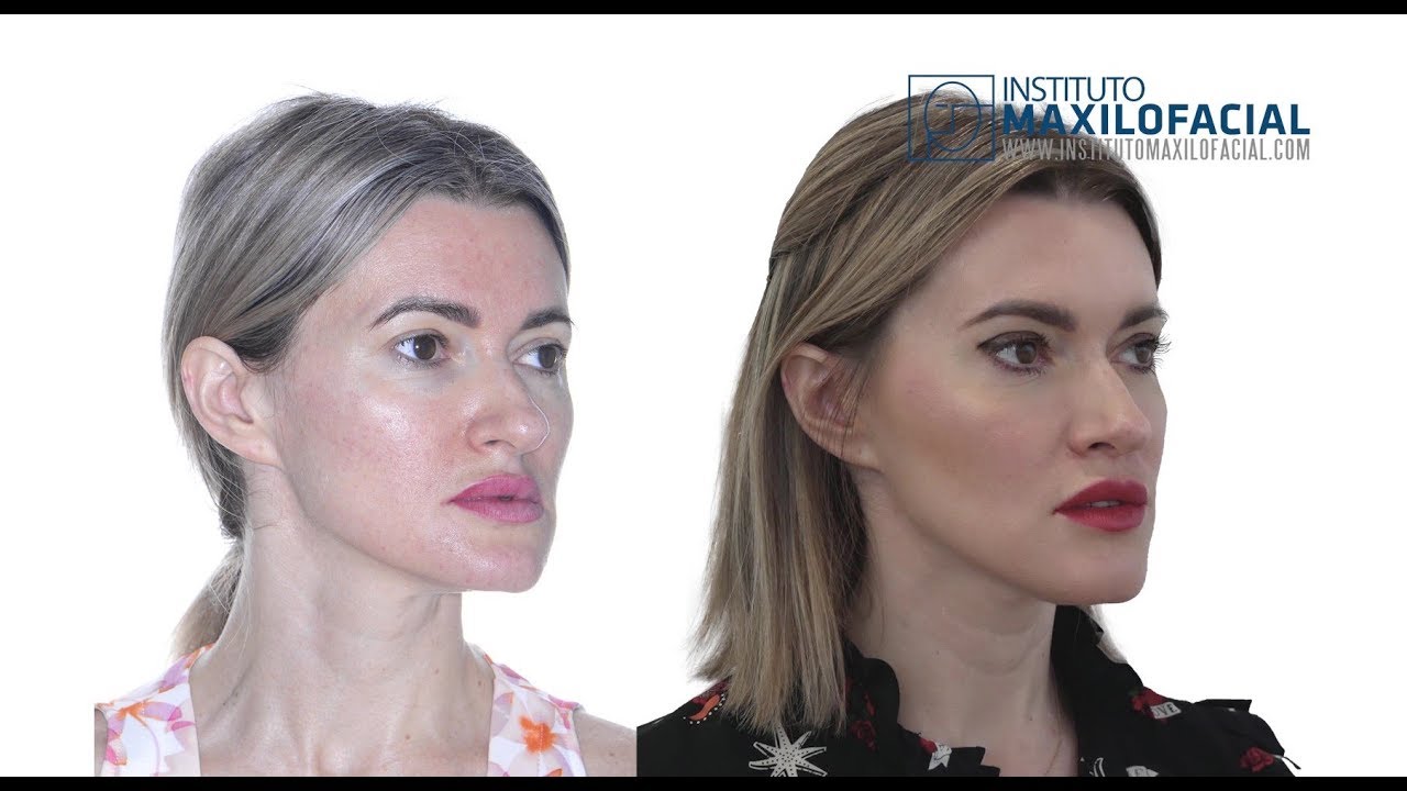 Bimaxillary orthognathic surgery. Case # 55: Natalia - Maxillary hypoplasia, mandibular asymmetry
