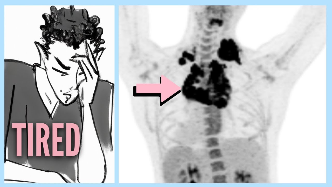 LYMPHOMA After Ignoring 6 WARNING Signs