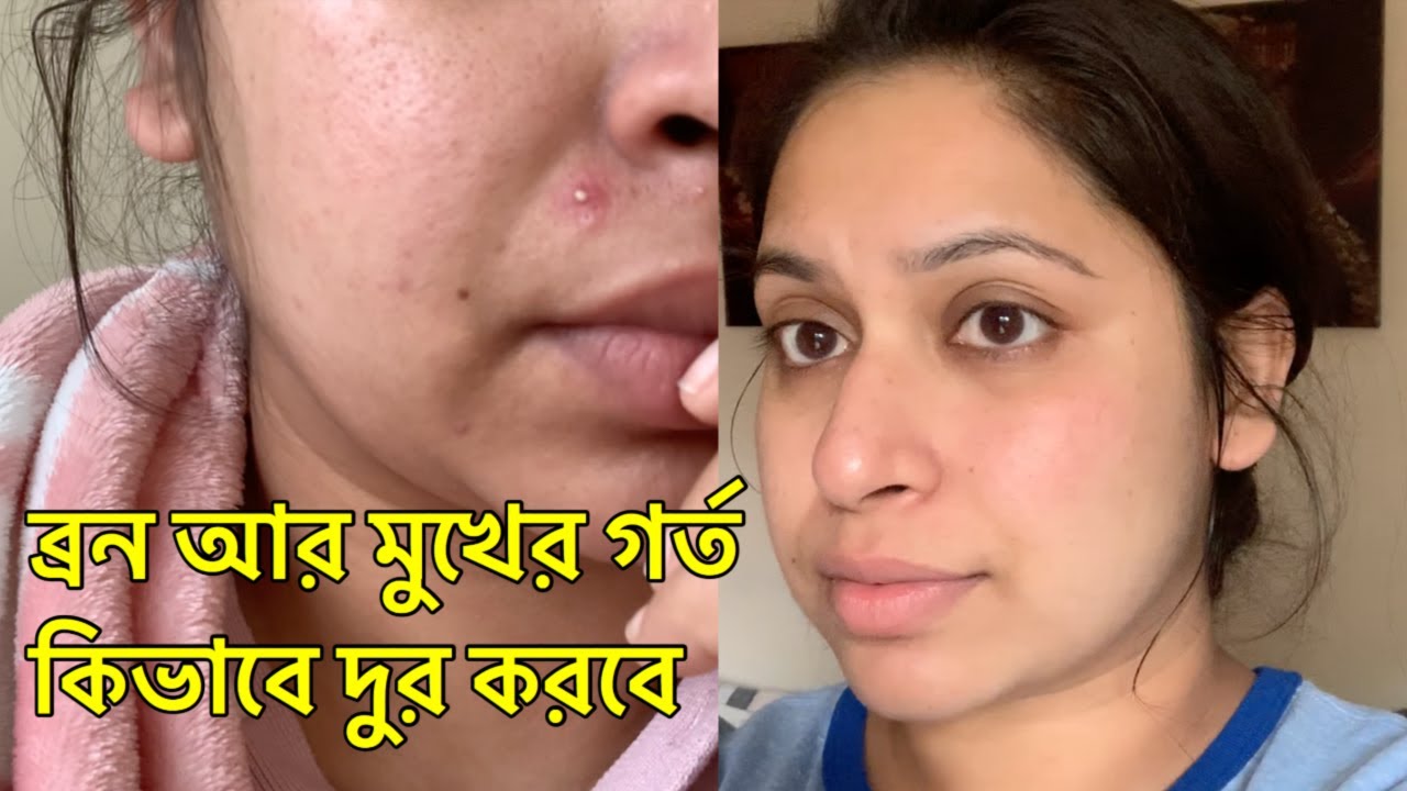 Remove Pores, Pimple And Get Bright Skin In Few Days | Shahnaz Shimul