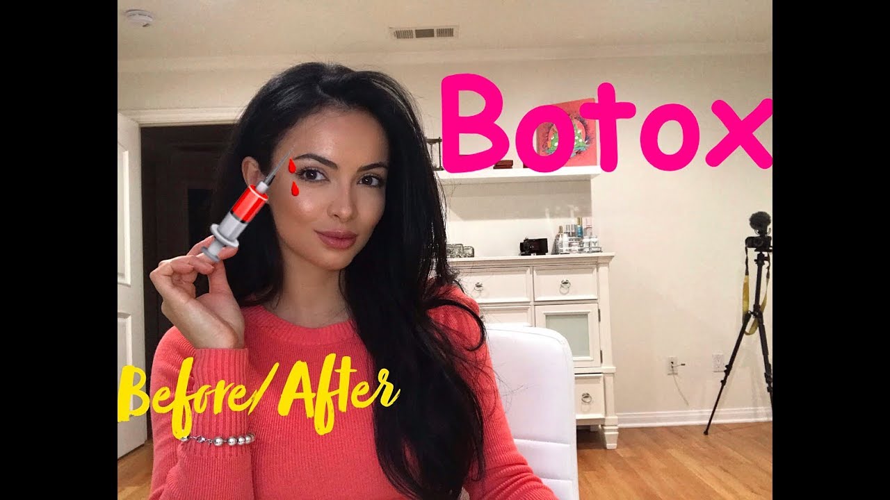 Botox Before and After Eyebrow Lift