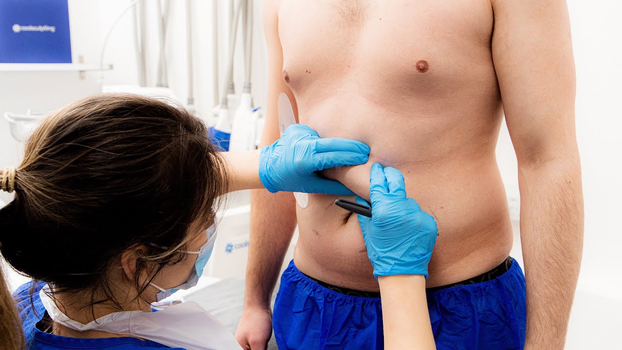 CoolSculpting для мужчин — эффективен ли криолиполиза? — Процедура коррекции фигуры.