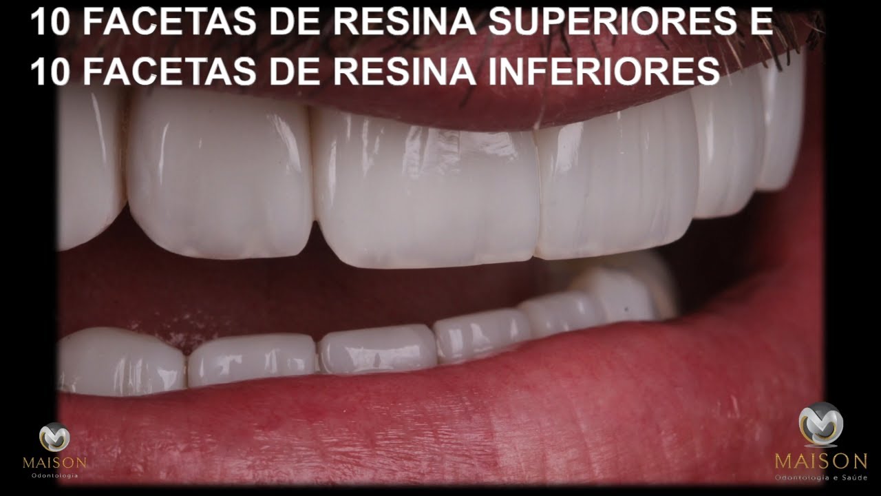 10 FACETAS DE RESINA SUPERIORES E 10 FACETAS DE RESINA INFERIORES