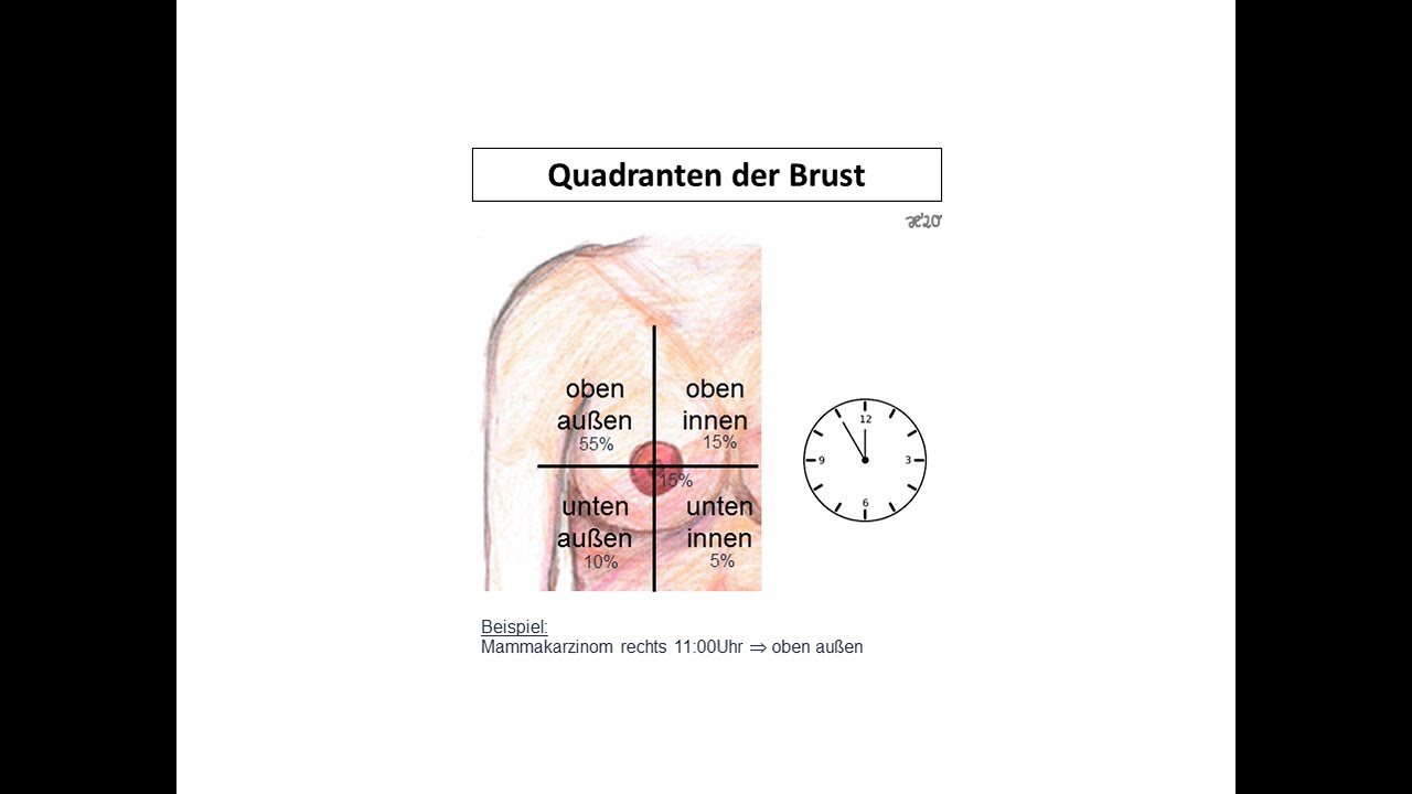 Quadranten der Brust | Strahlentherapie Prof. Hilke Vorwerk