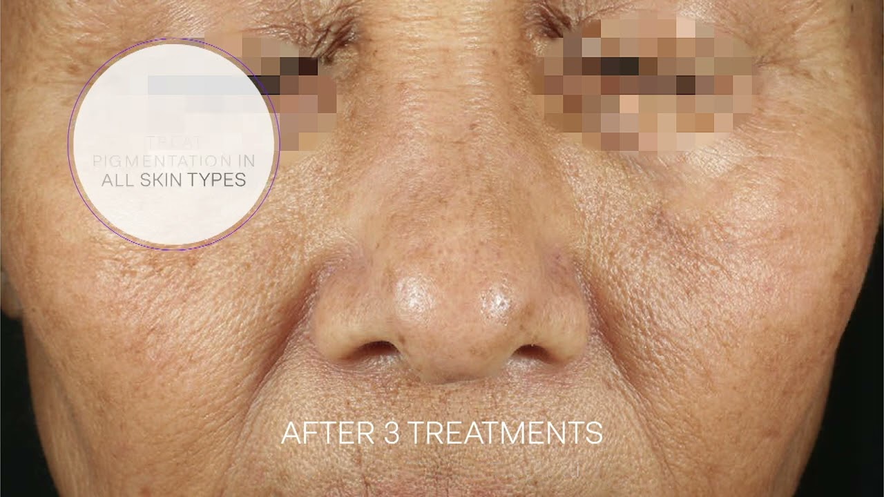 PicoSure Pro MOA Videos 2