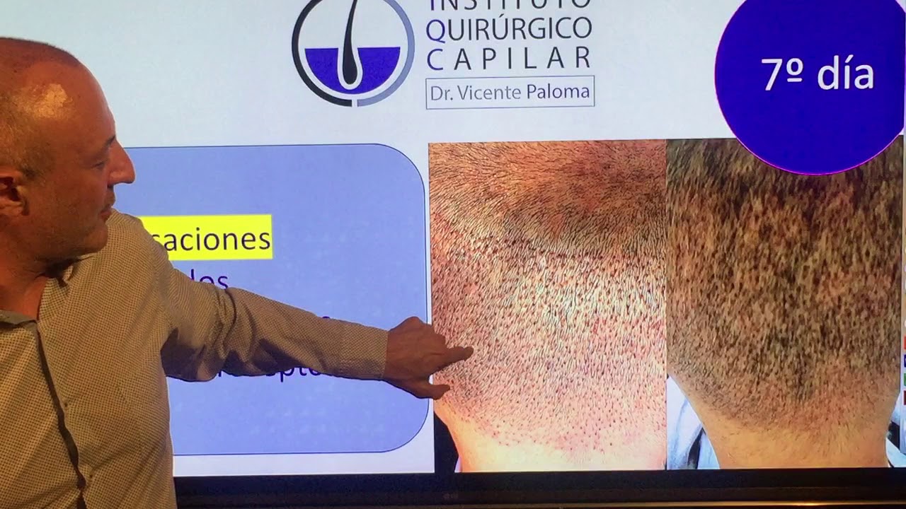 7 dias despues del injerto capilar
