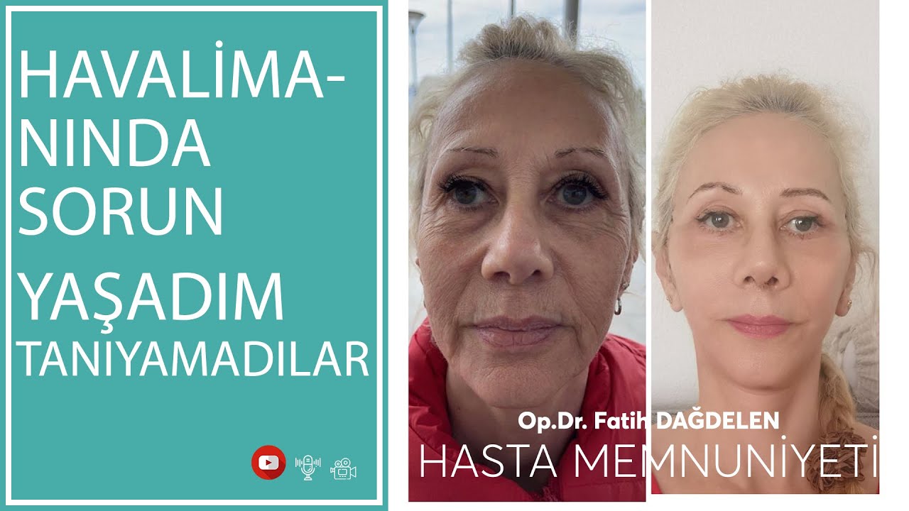 Yüz Gençleştirme Estetiği Sonrası