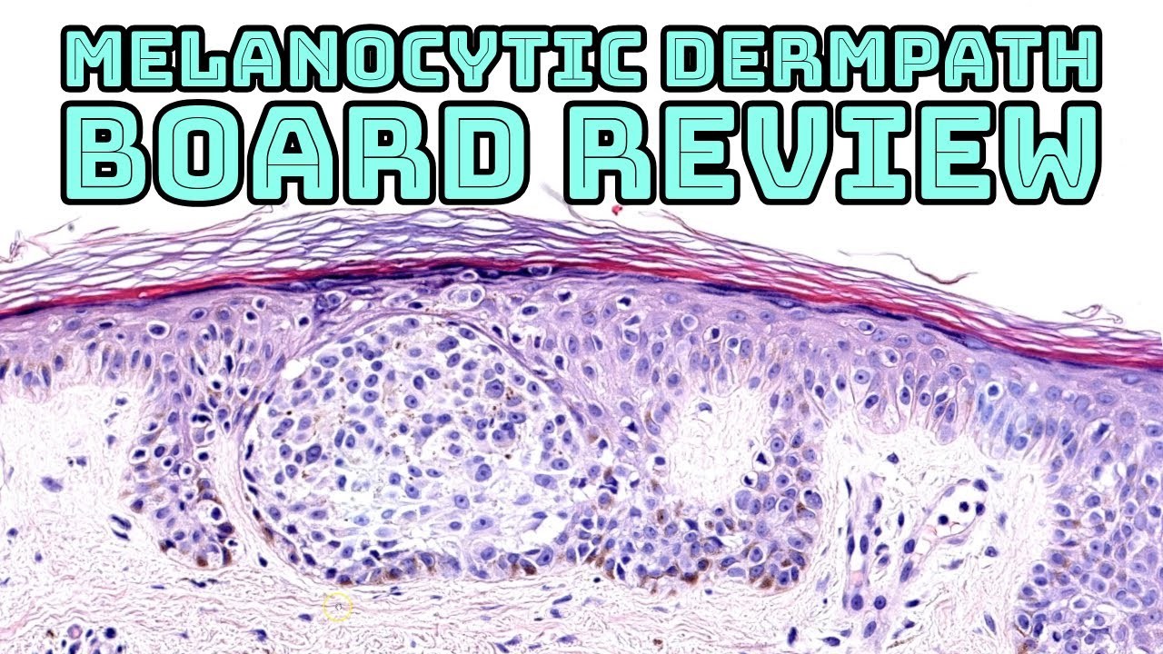 Melanocytic Dermpath Board Review (melanoma, blue nevus, other nevi, & mimics) pathology dermatology