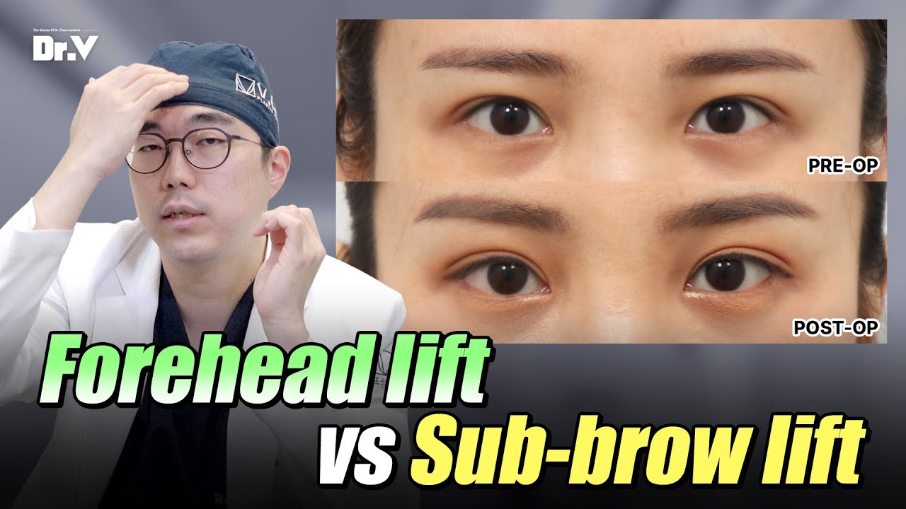 Facelift FAQ) Endoscopic Forehead Lift Vs. Sub-brow Lift?