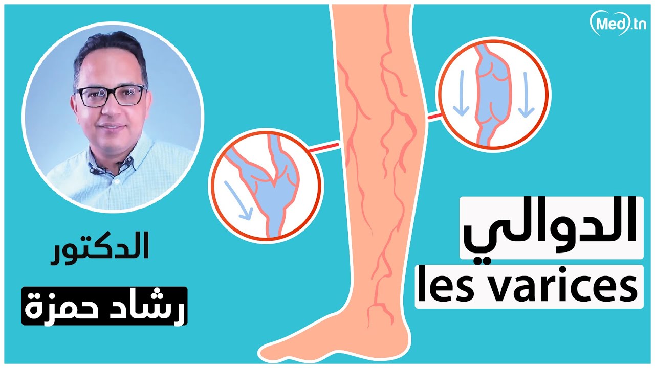 ماهو مرض الدوالي؟ و ماهي أعراضه؟ | الدكتور رشاد حمزة