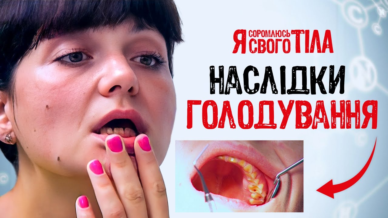 Потеряла зубы из-за анорексии – Я соромлюсь свого тіла | ЛЕЧЕНИЕ | ДОКАЗАТЕЛЬНАЯ МЕДИЦИНА | БОЛЕЗНИ