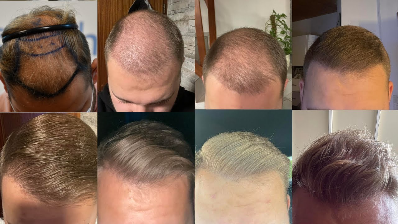 Greffe capillaire d'Adrian avant/après | Tonsure | Elithair