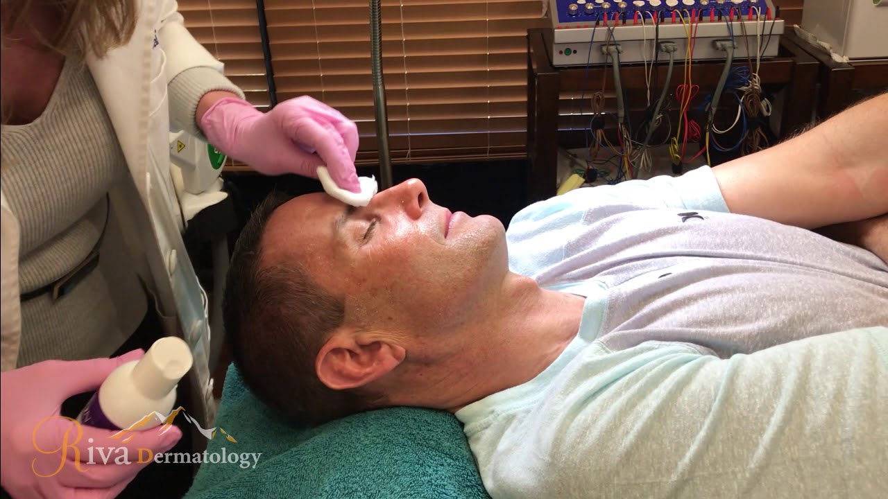 Laser IPL Treatment