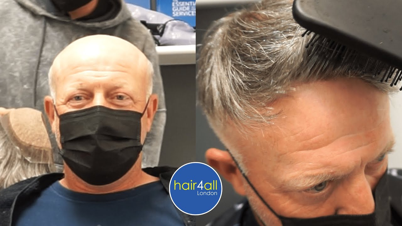 Before & After | Hair System | Non-Surgical Hair Replacement System Men/Women | UK/USA/International