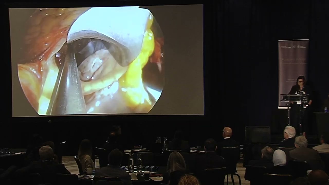 How to Perform an Effective Eeptal Myectomy - Rachel Vanderlaan
