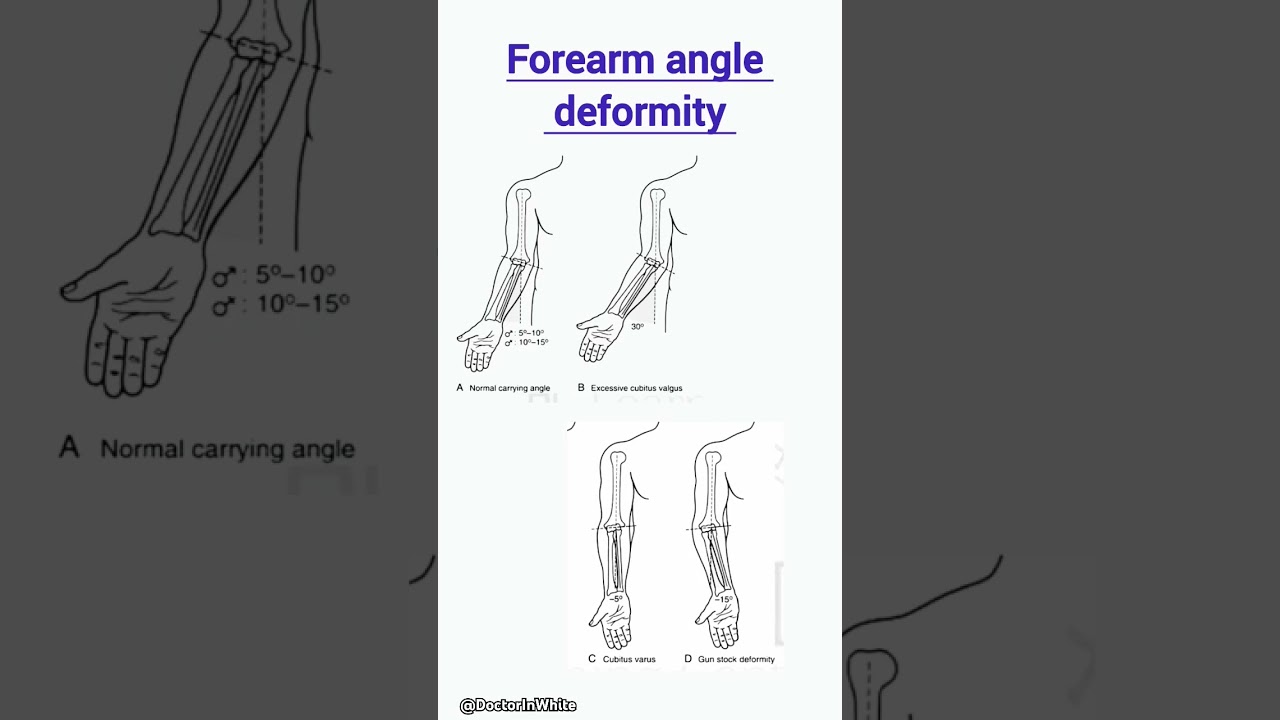 Forearm angle deformity | #forearms #deformity #varus #valgus #gunshot #orthopedics