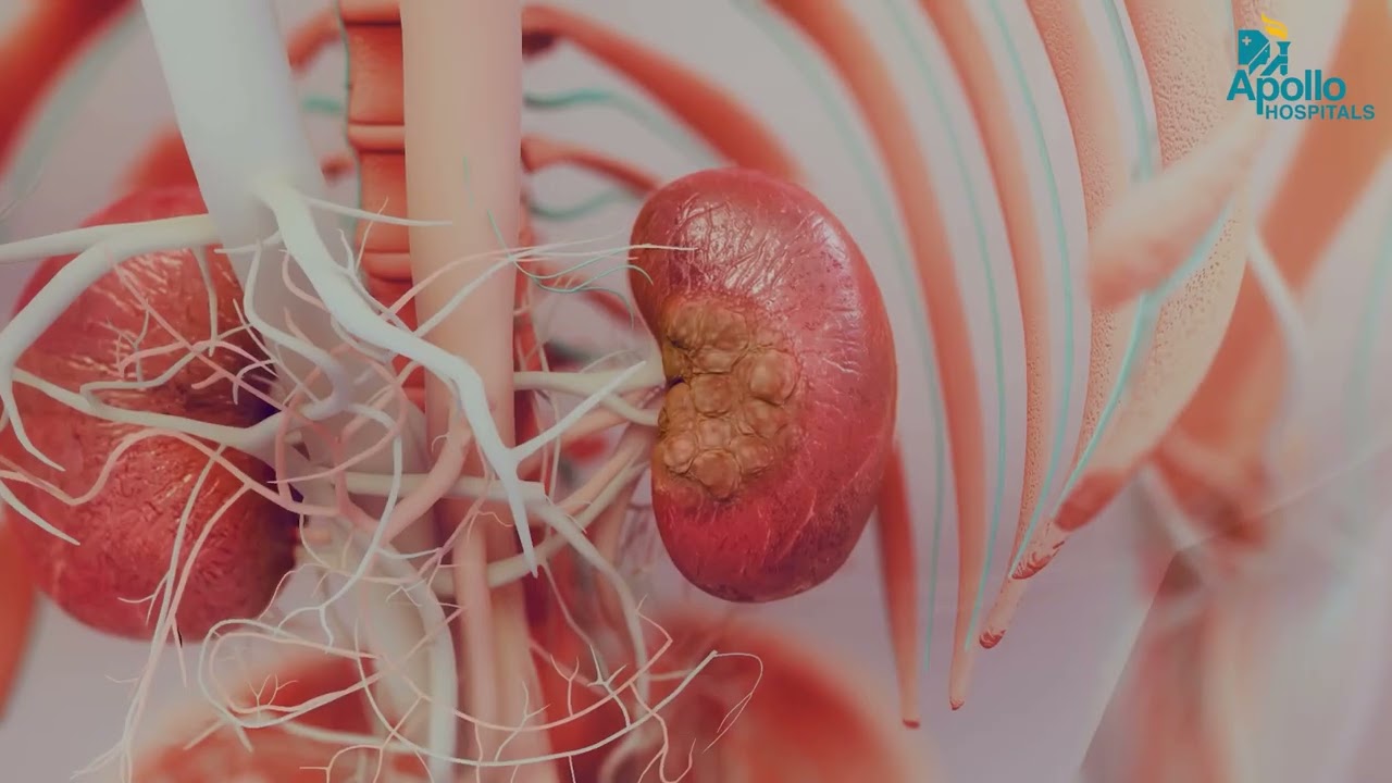 Hydronephrosis in Children: Diagnosis & Treatment Explained | Dr. Balamourougane P | Apollo Hospital