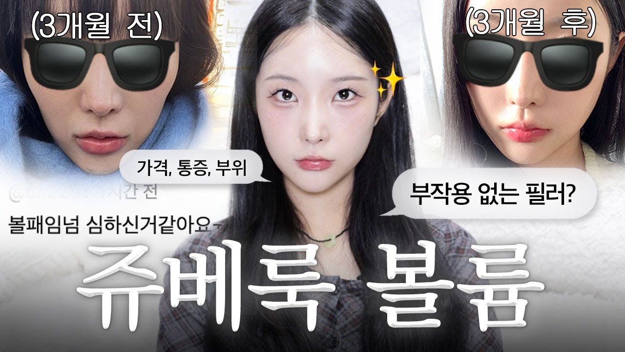부작용 없는 필러?💉3개월만에 볼패임 해결한 쥬베룩볼륨 총정리🐣 | 가격,통증,유지기간,후관리,병원고르는팁,추천vs비추천등등..