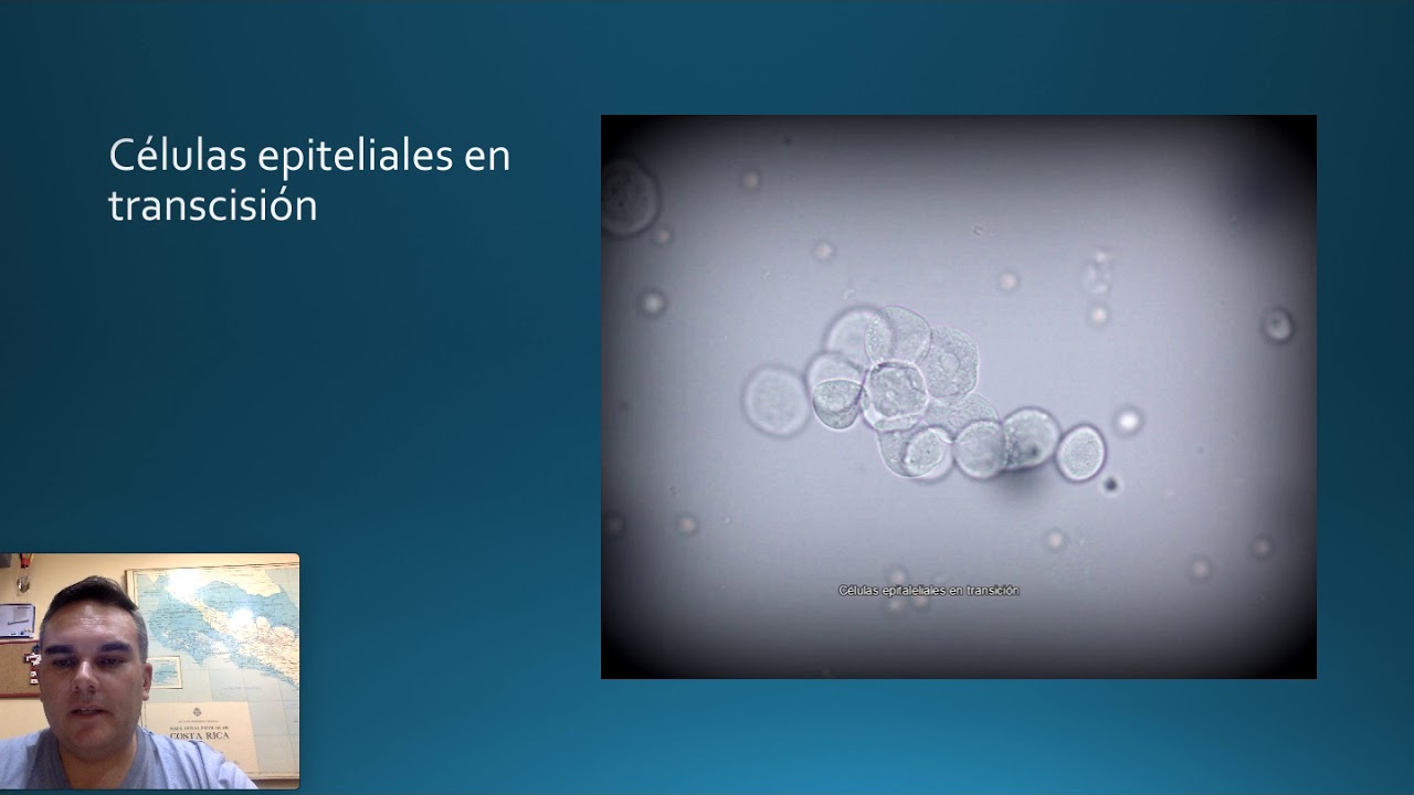 Observación microscópica del sedimento urinario