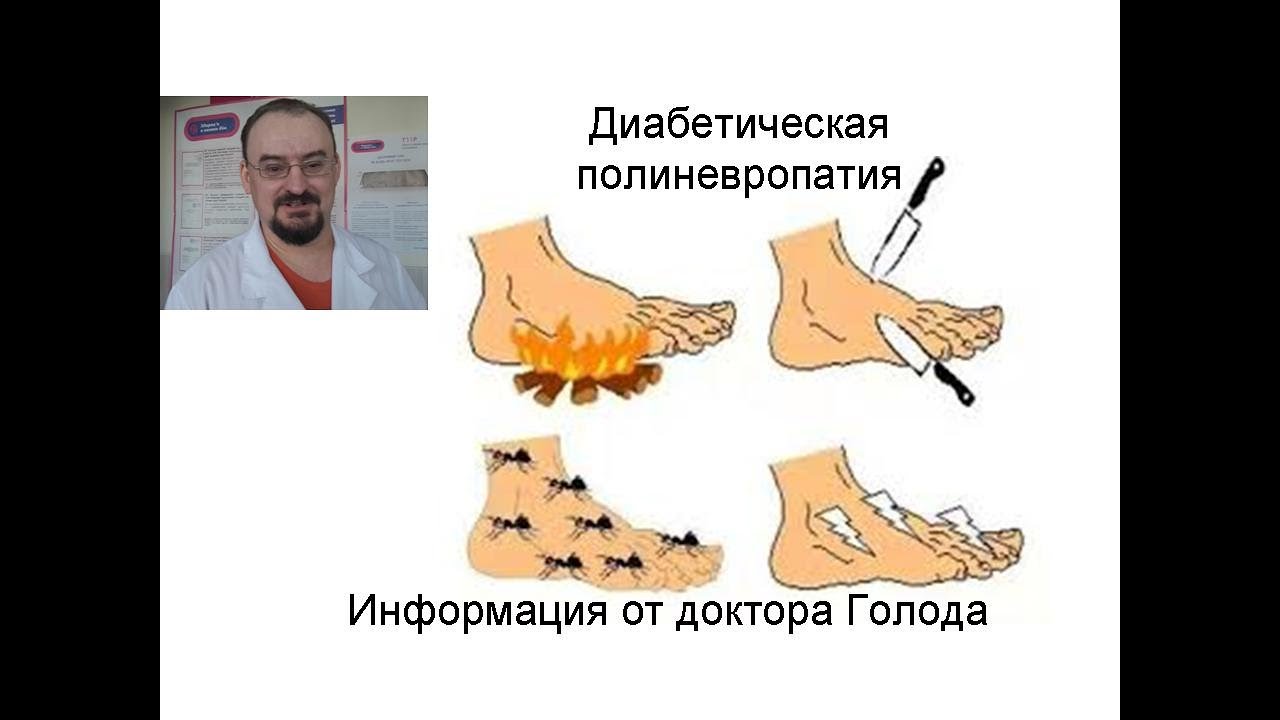 Диабетическая полиневропатия.  Её лечение