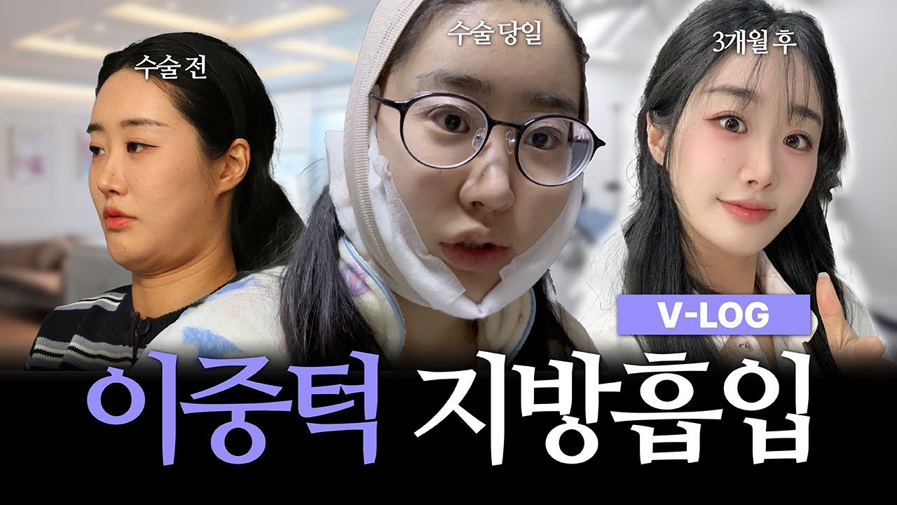 [이중턱 지방흡입+근육묶기 V-LOG] 다이어트해도 절대 안빠지는 이중턱, 고민이신분들 꼭 확인하세요!