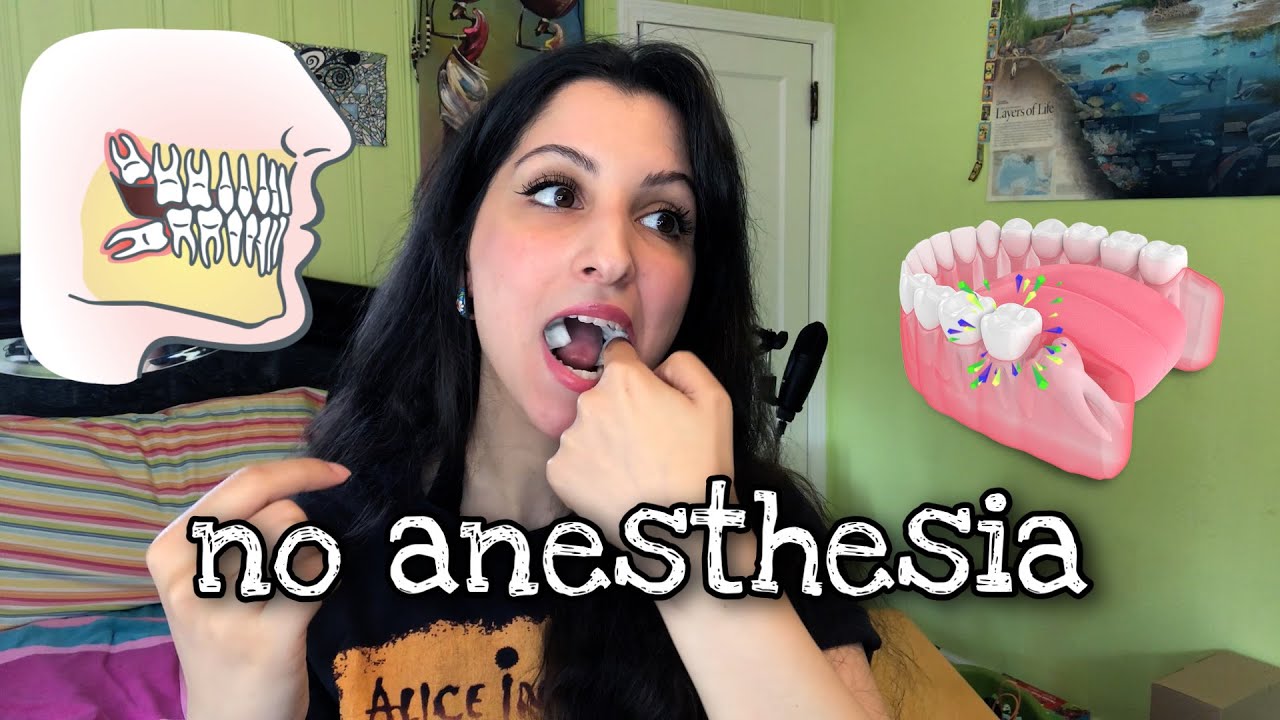 Wisdom Teeth Survival Guide (NO General Anesthesia)