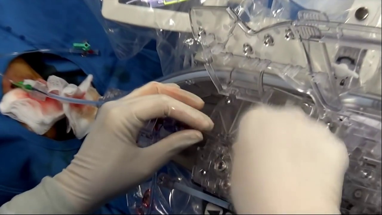 Robotic PCI of LAD Lesion