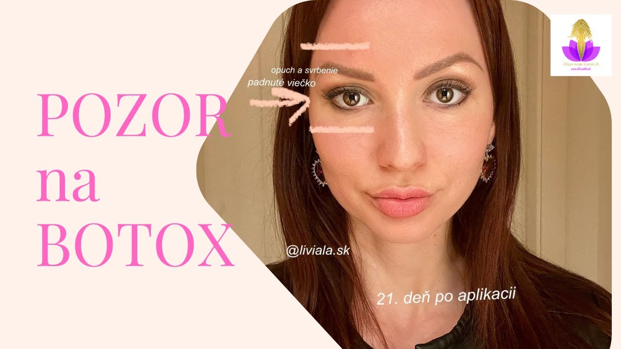 POZOR NA BOTOX 💉