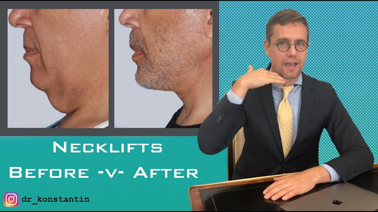 Neck Lift Transformation: Before & After
