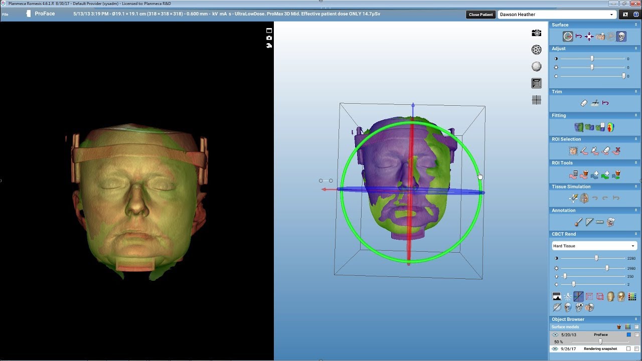 Mapping ProFace image to CBCT in Planmeca Romexis©