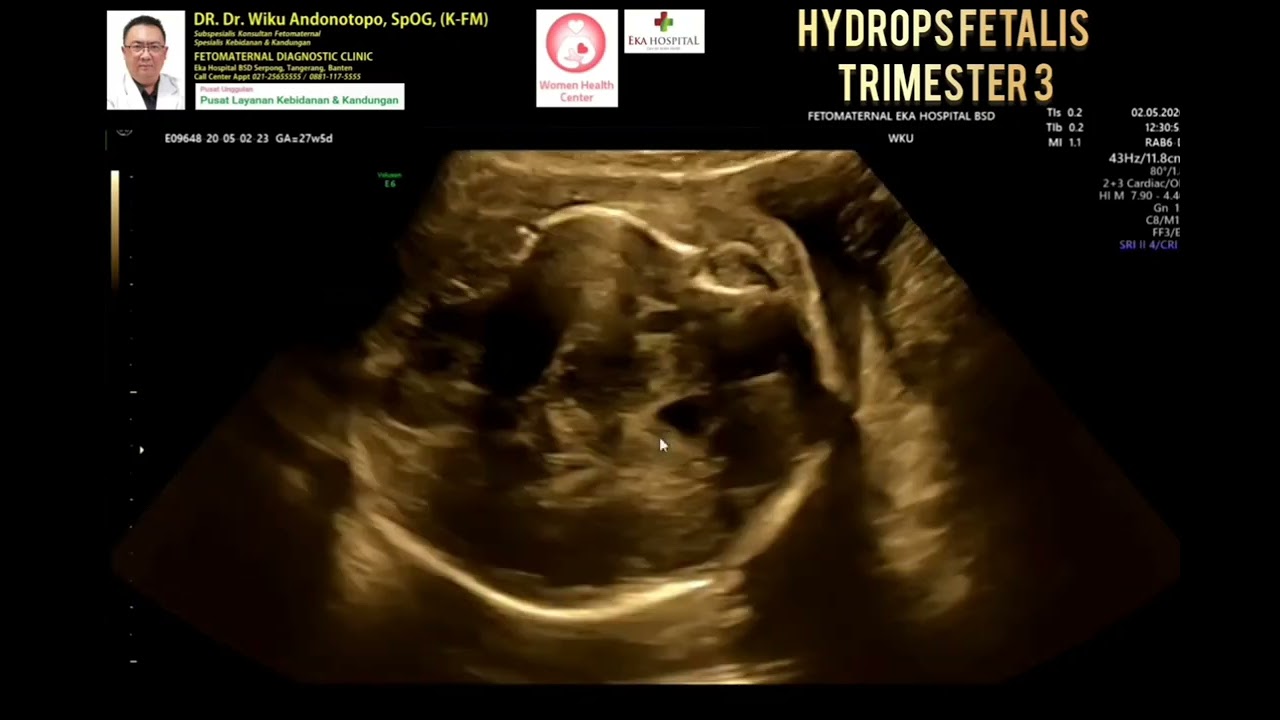 hydrops fetalis trimester III