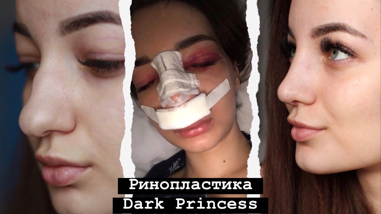 РИНОПЛАСТИКА DARK PRINCESS | одна в Ереване | ДО и ПОСЛЕ