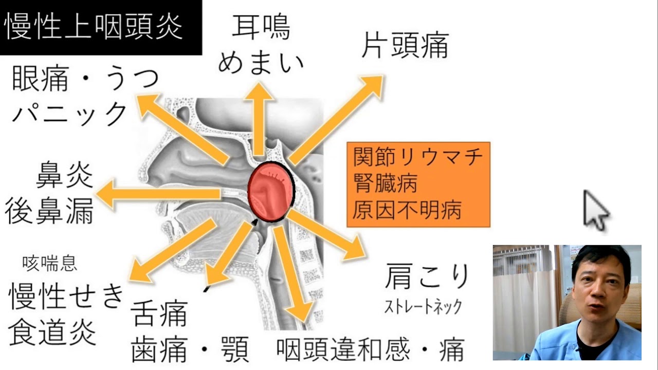 【医師が解説】脳脊髄液減少症と慢性上咽頭炎について【なかなか治らない？！】