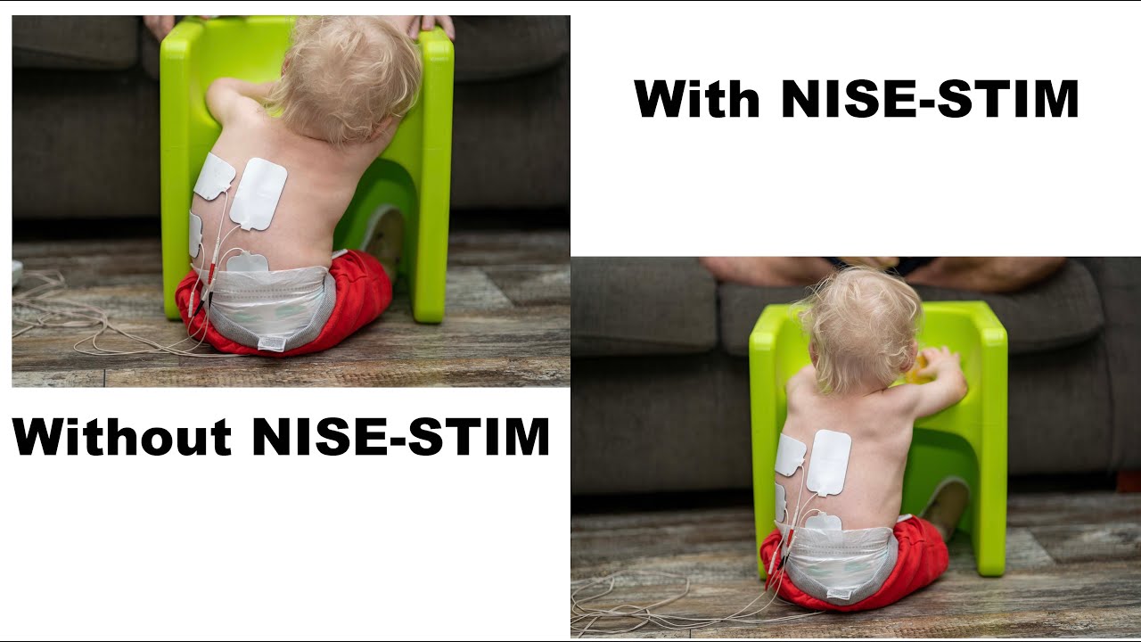 Spinal Electrical Stimulation/NISE Stim Presentation by Gerti Motavalli