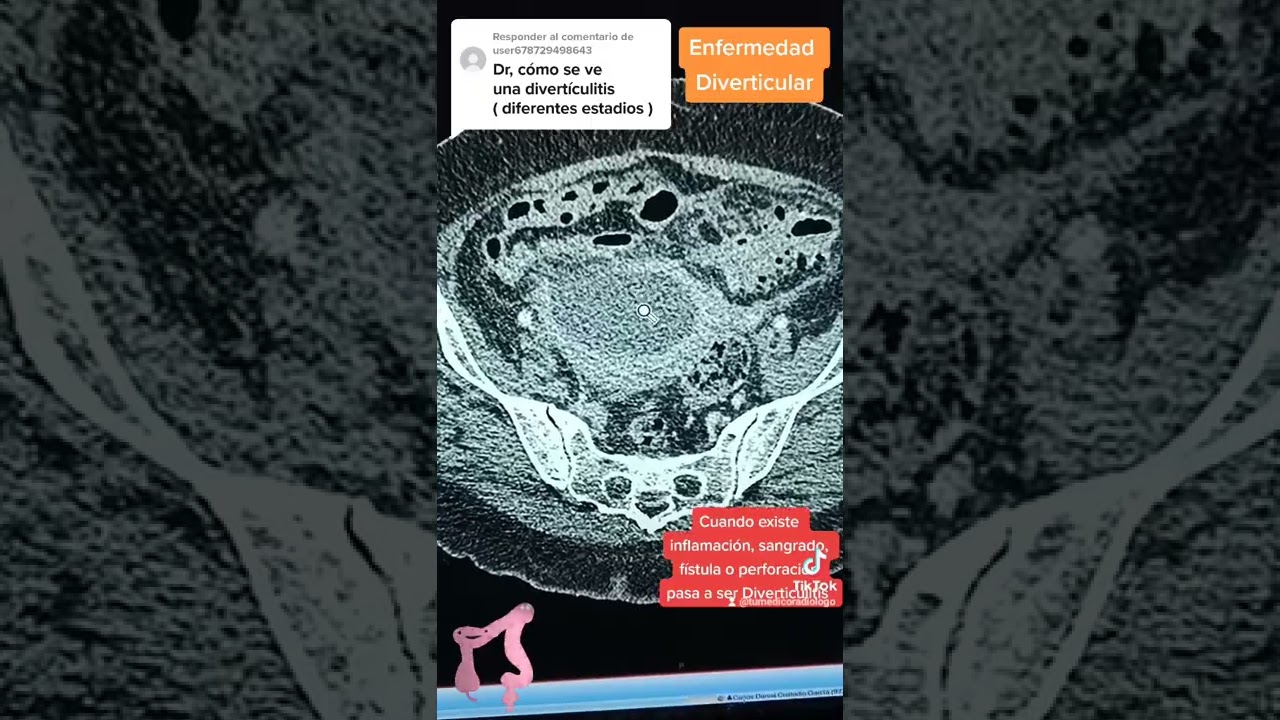 Diverticulitis por tomografia !!
