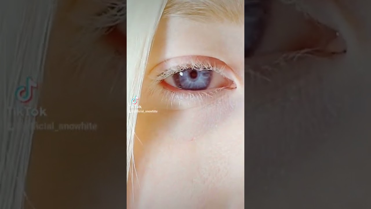 #albino #albinism #eyes #nystagmus #shorts