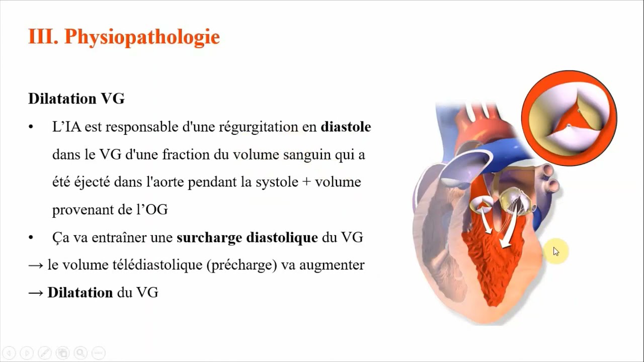 07. Insuffisance aortique (Dr M.S.Lounes) | #Cardio