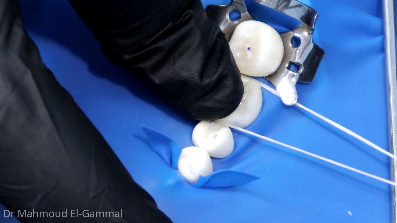 10- Floss Tie for apical displacement of the Rubber Dam