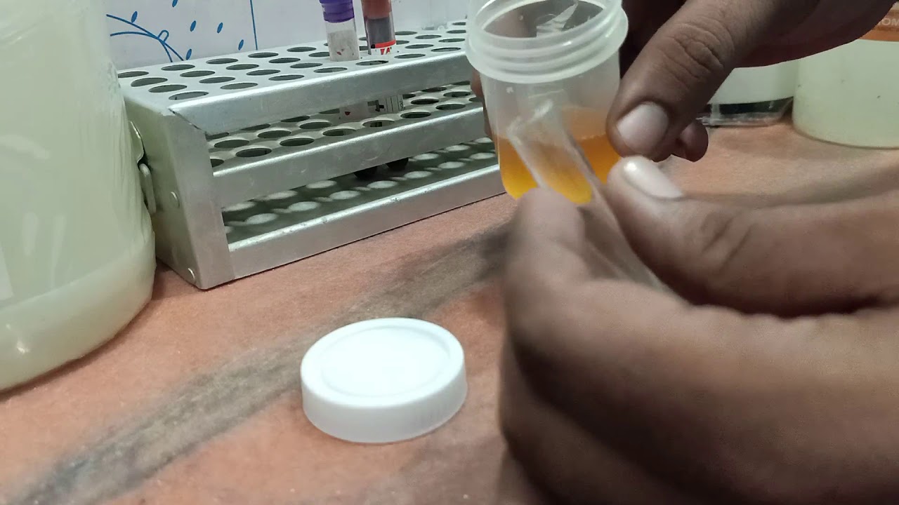 URINE BILIRUBIN