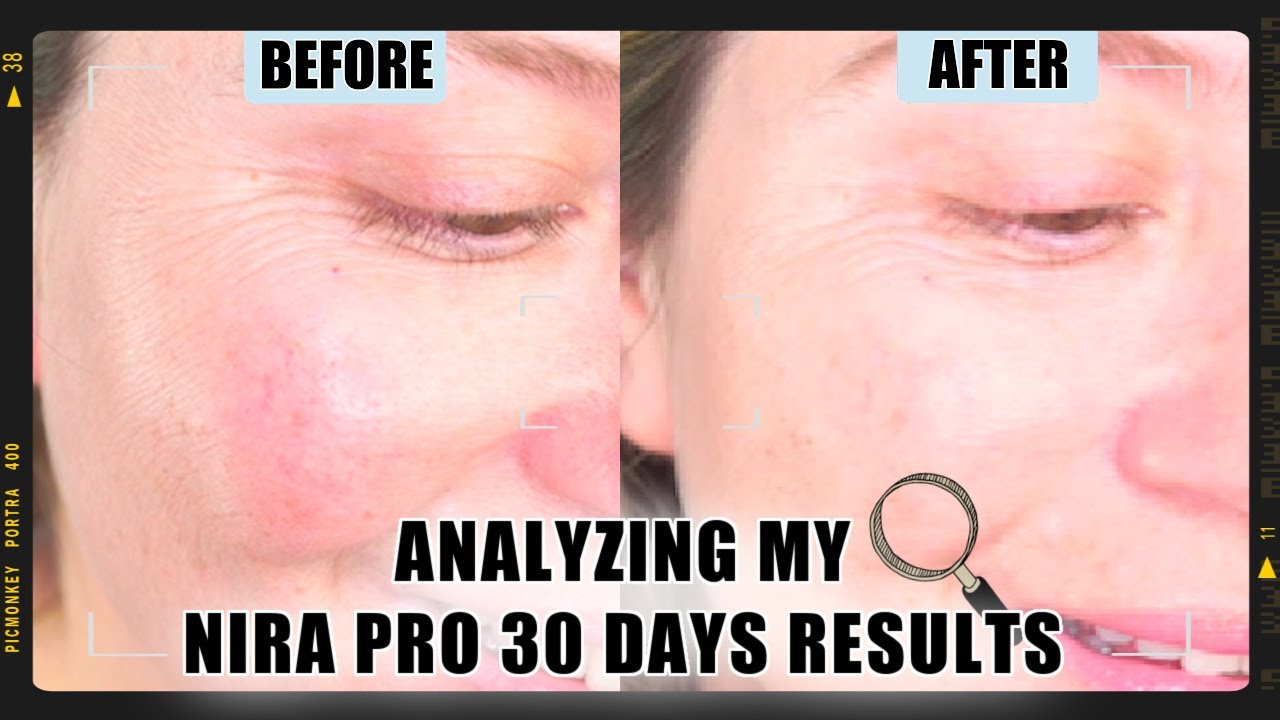 NIRA PRO 30 DAYS RESULTS | ANALYZING MY BEFORE & AFTERS 🔍