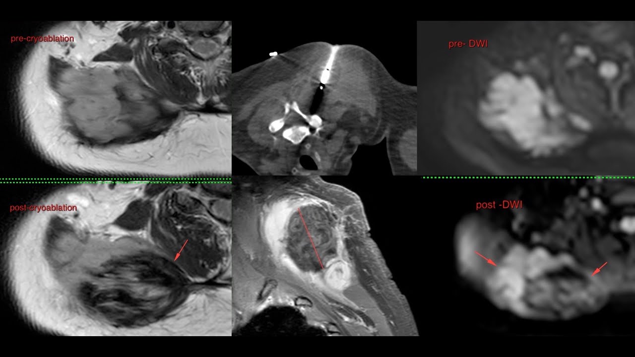 Case 53: Cryoablation of Posterior Thoracic Wall Fibromatosis