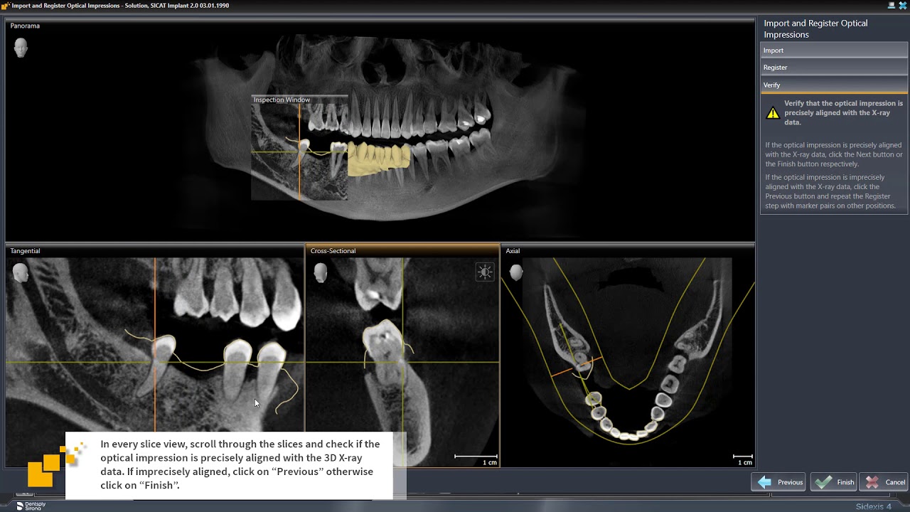 SICAT Implant 2.0 - Import & Register Optical Impressions