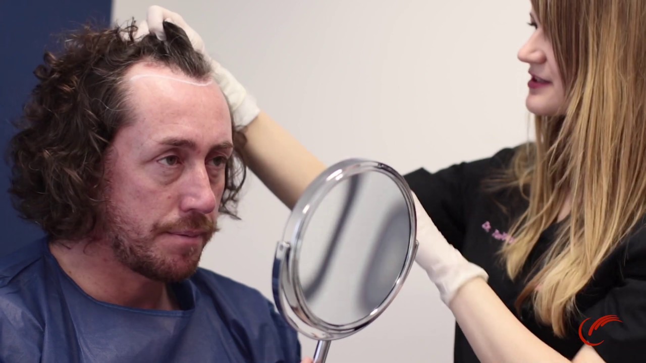 Dancing On Ice star Ryan Sidebottom describes the effect of hair loss on his mental health