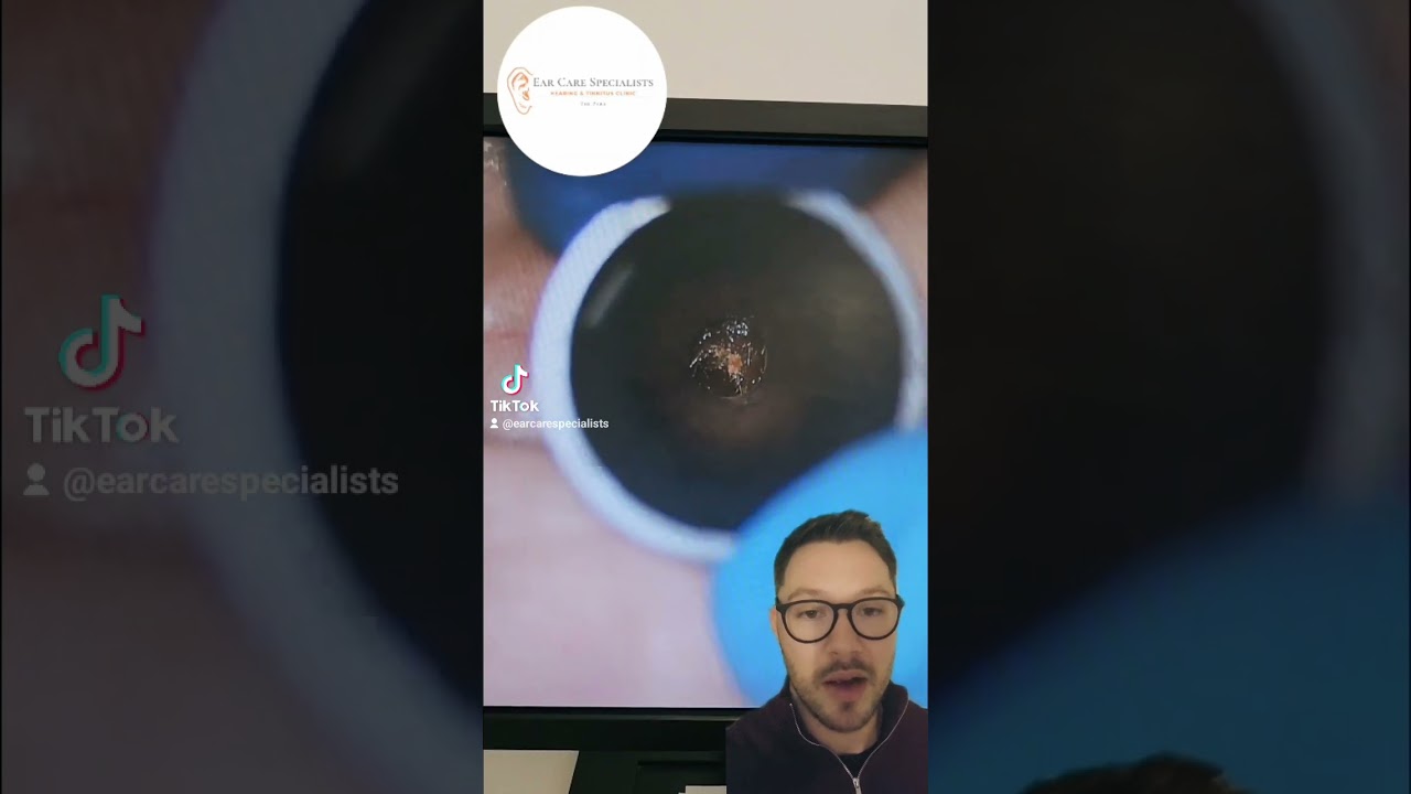 Double trouble ear wax plug removal #ear #earwax #earwaxremoval #audiology #earcarespecialists