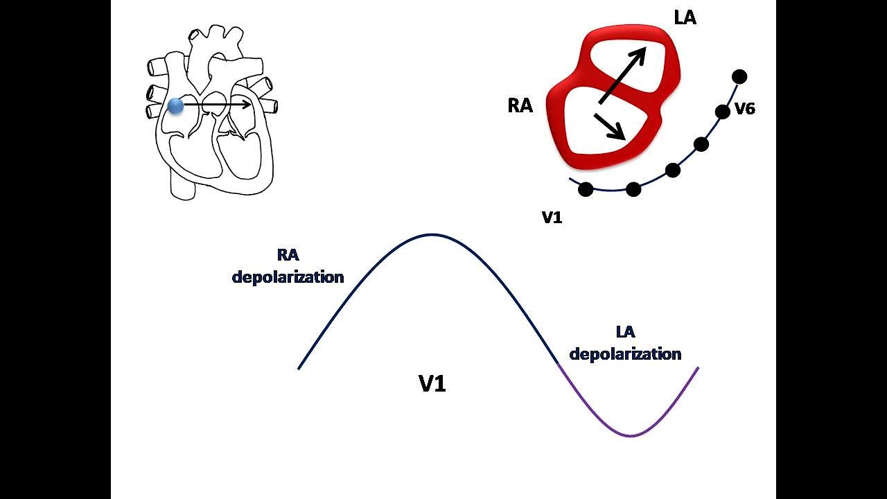 ECG course: Atrial Enlargement, Dr. Sherif Altoukhy