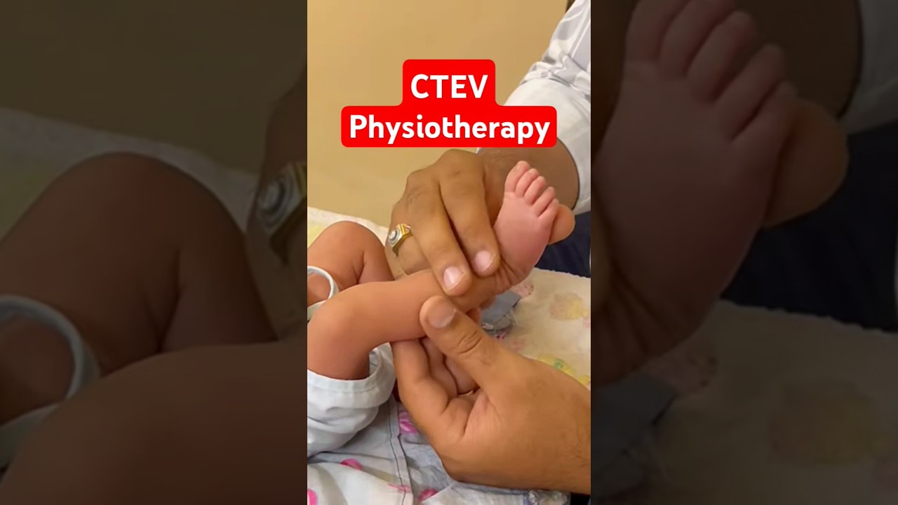 CTEV Baby Physiotherapy | Congenital Talipes Equinovarus Exercise at Home #physiotherapy #shorts