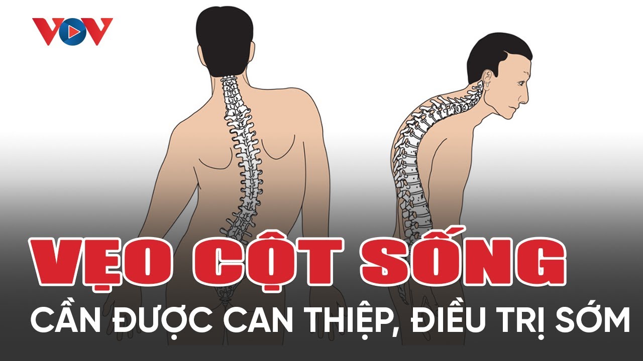 Bệnh lý gù vẹo cột sống cần được can thiệp, điều trị sớm!